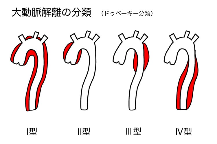 大動脈解離イメージ