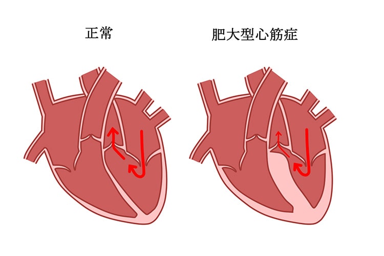 肥大型心筋症イメージ