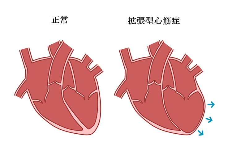 拡張型心筋症イメージ