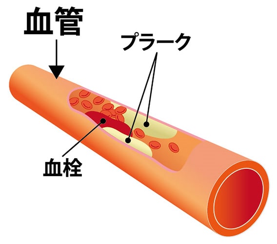 動脈硬化症